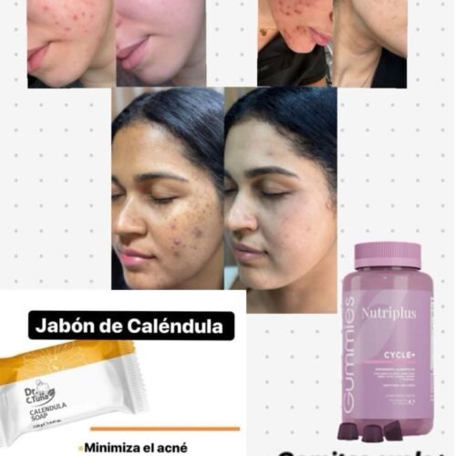 TRATAMIENTO PARA EL ACNE
