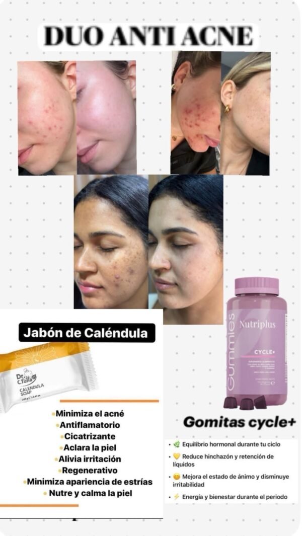 photo-output TRATAMIENTO PARA EL ACNE